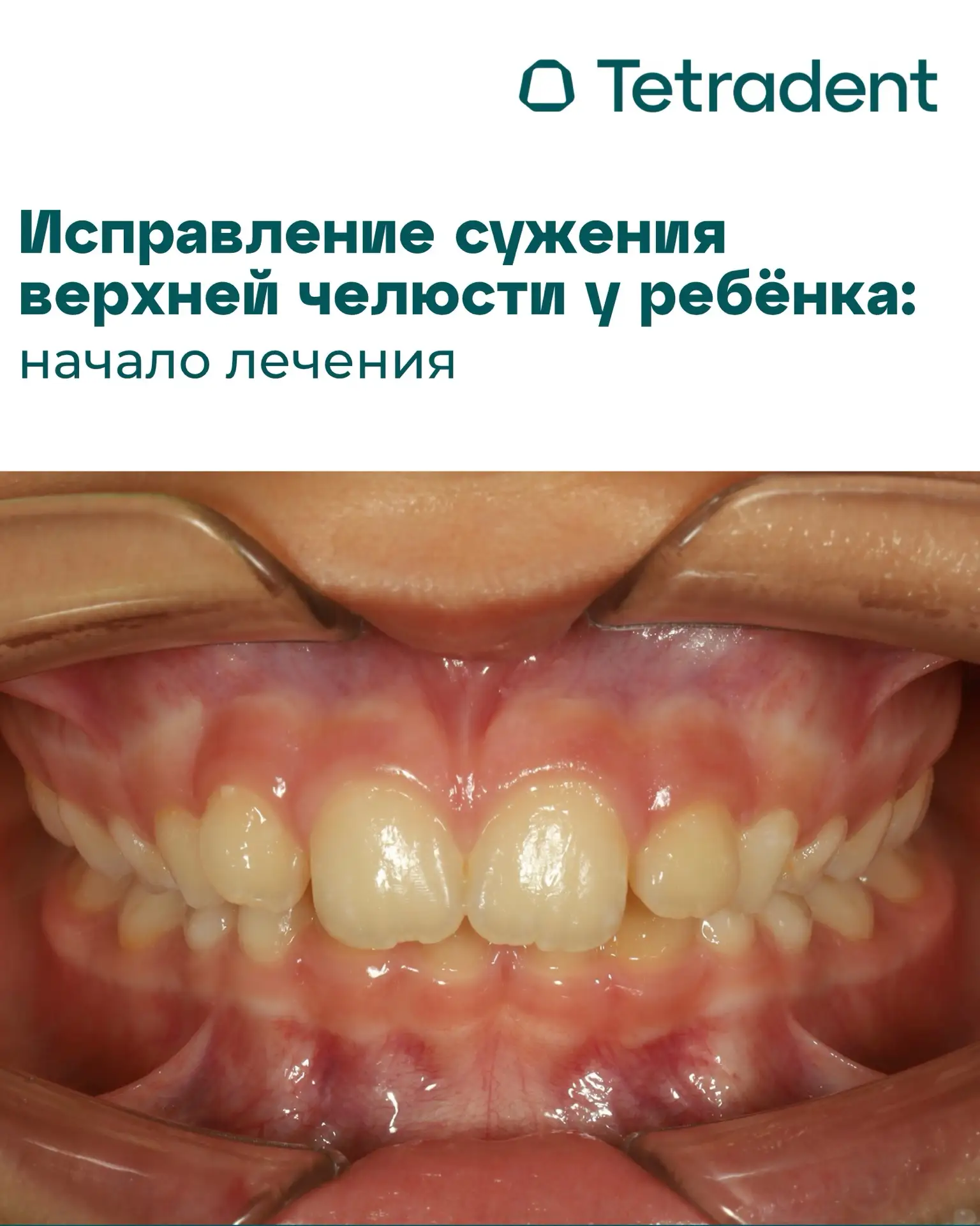 Исправление сужения верхней челюсти у ребёнка: следим за прогрессом вместе!

В этой карусели мы пока