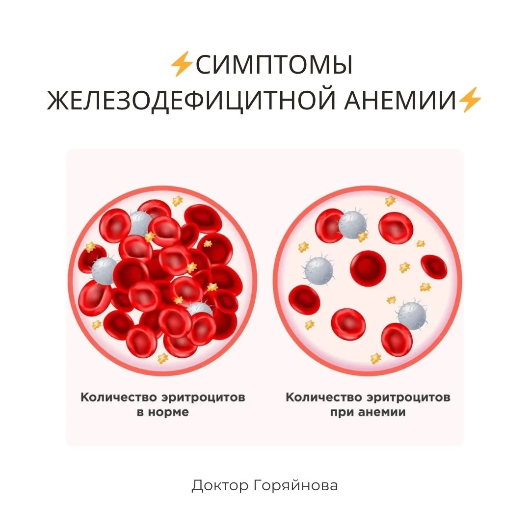 Основными клиническими проявлениями ЖДА являются гипоксический и сидеропенический синдром.

Гипоксич
