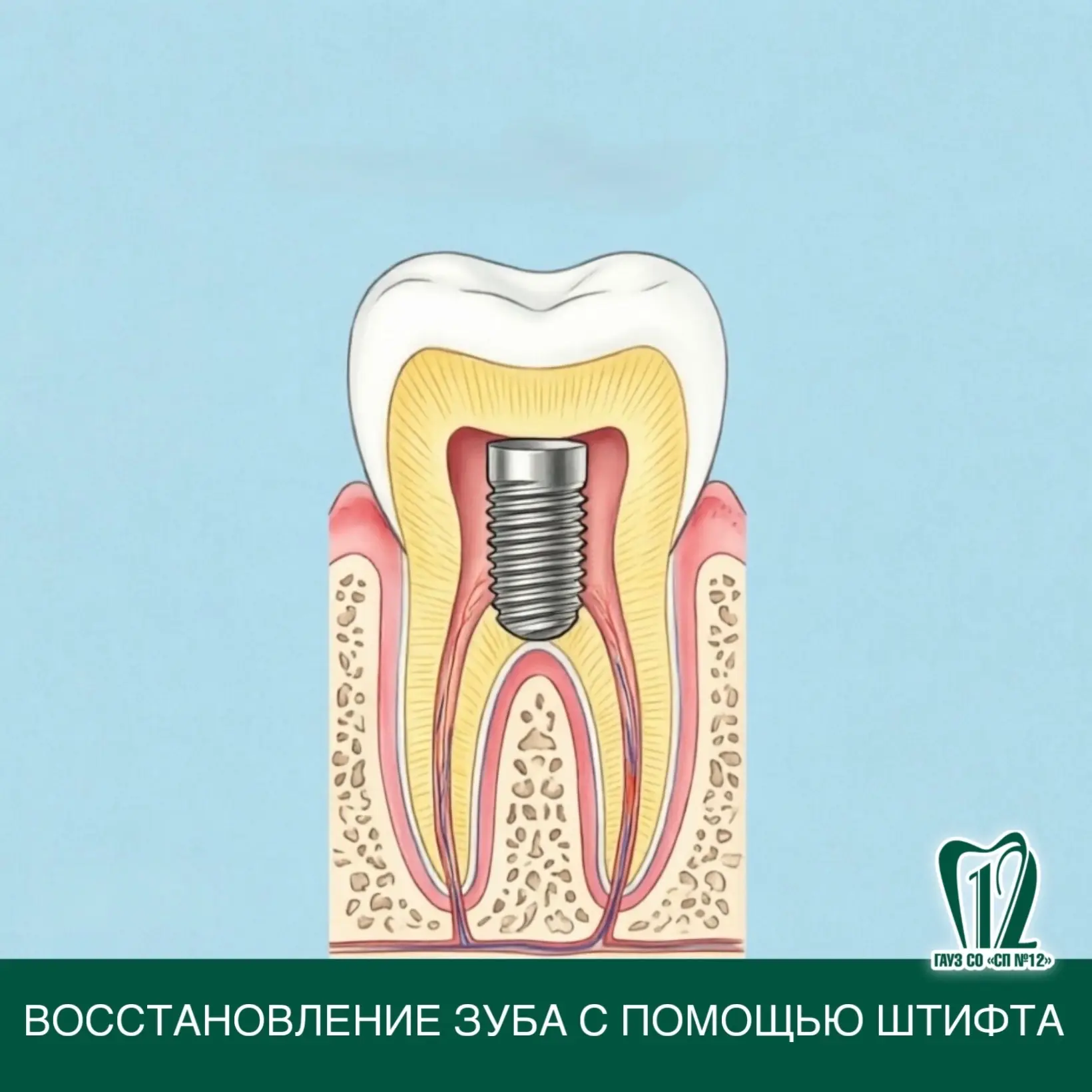 Восстановление зуба с помощью штифта.