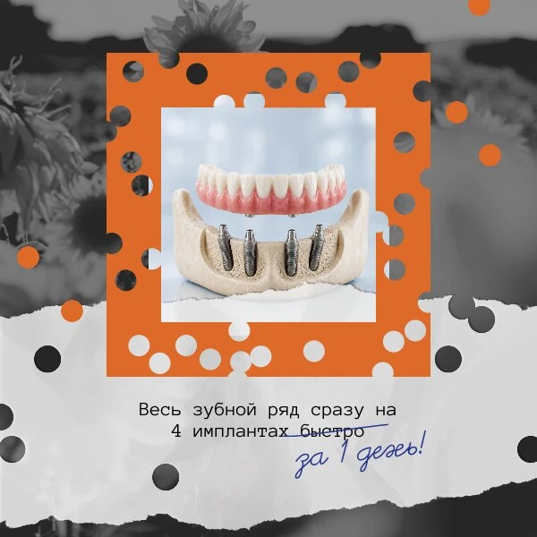 Несъёмное протезирование на 4-х имплантах в г.Пермь.