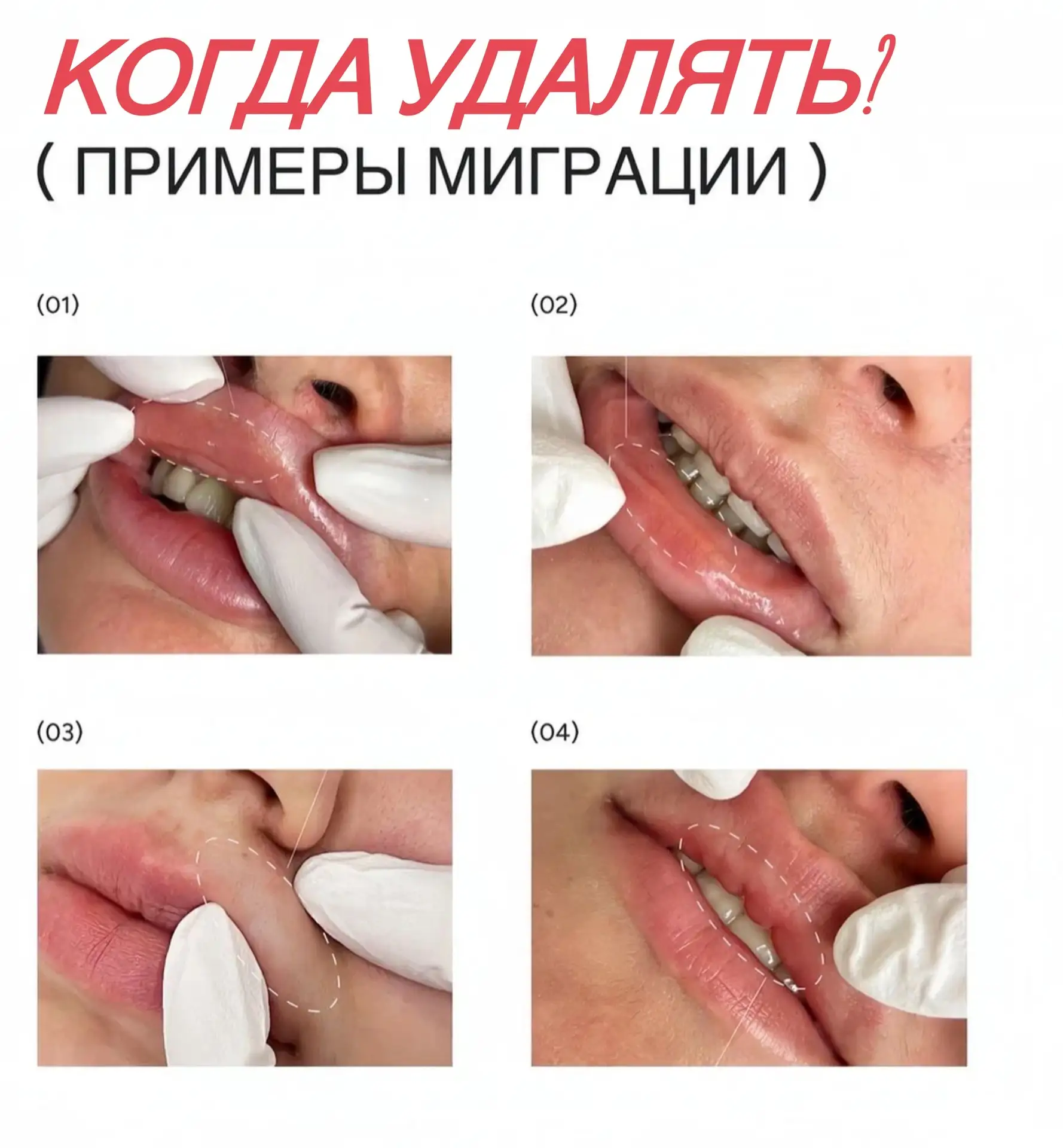 Сегодня косметологи пытаются вывести тему удаление филлера, как процедуру, которая показана чуть ли 