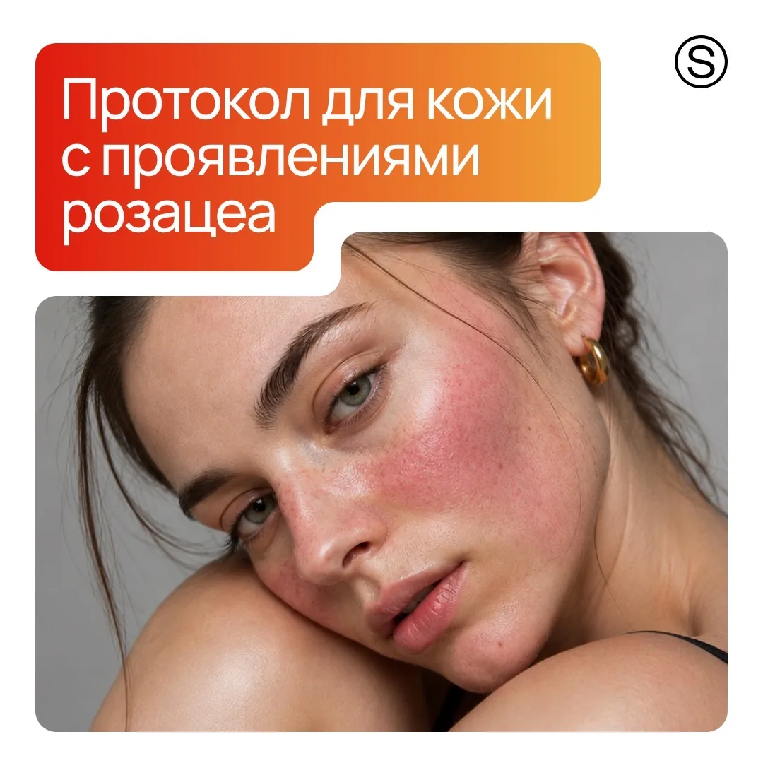 В мае розацеа тоже "расцветает": температура, солнце, пыль, пыльца и аллергия ударяют п...