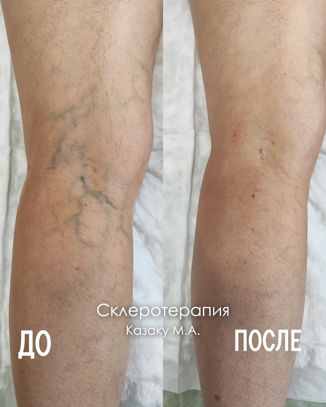 РЕЗУЛЬТАТ СКЛЕРОТЕРАПИИ⚡️