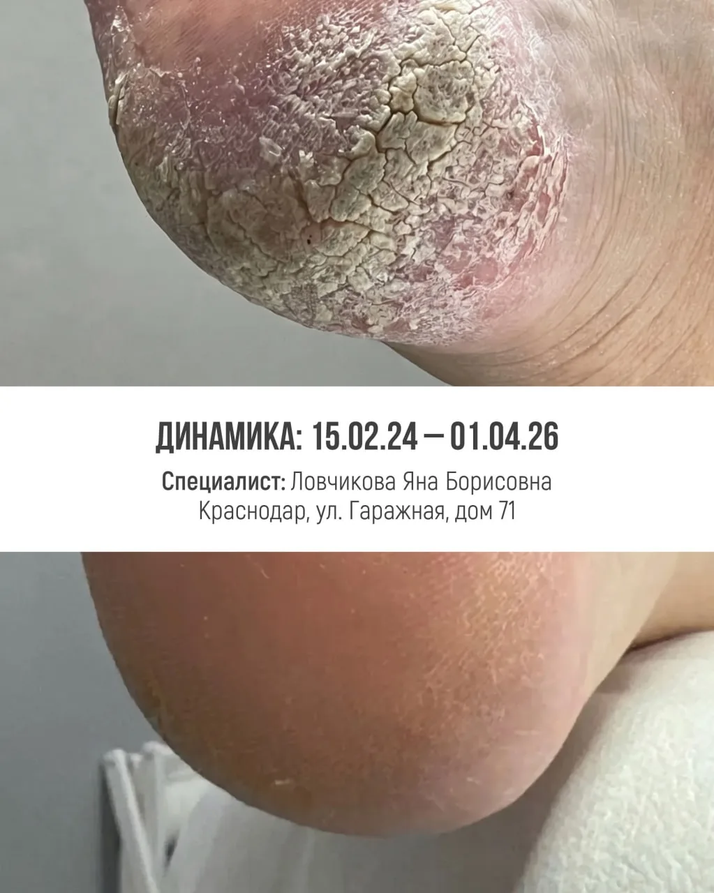 При работе с трещинами и хронической сухостью кожи важно понимать: здесь недостаточно просто увлажни