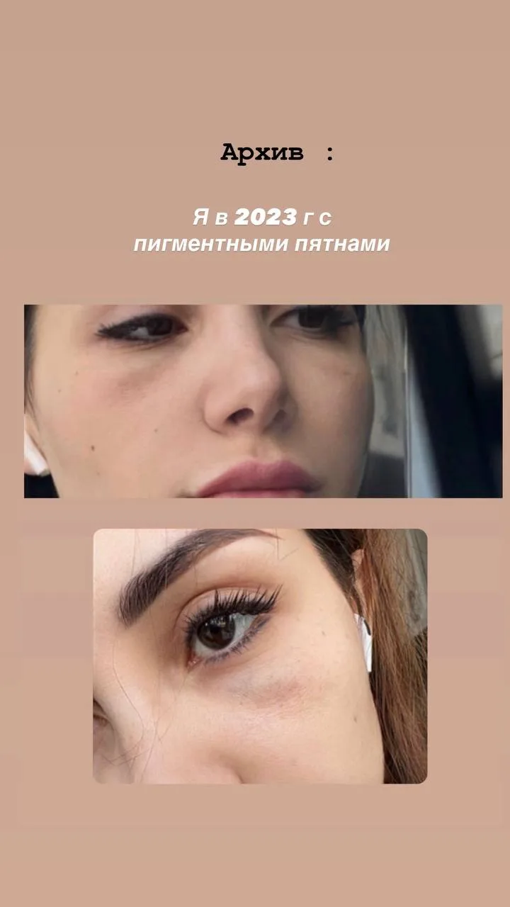 👋 Хочу поделиться, как мне удалось избавиться от пигментных пятен!