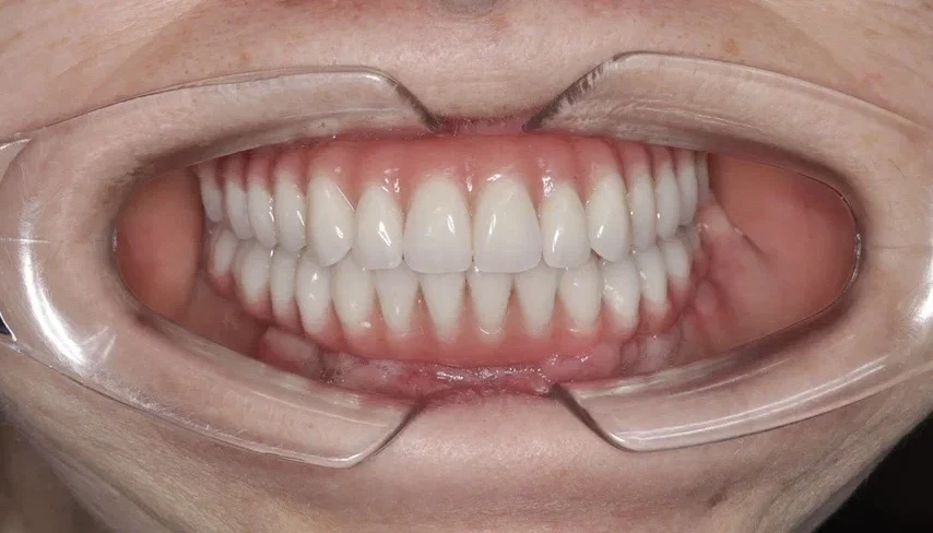ДО/ПОСЛЕ. История нашей пациентки Людмилы 🦷  Восстановили все зубы за 3 дня!  Людмила Петровна обрат