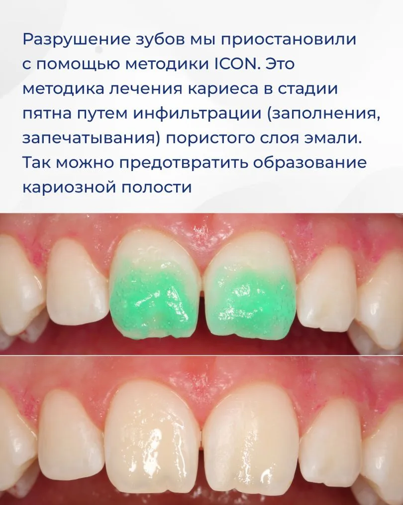 Устраняем дисколорит зубов за одну процедуру! Как это возможно? Сейчас расскажу! Пациентке 11 лет. Б