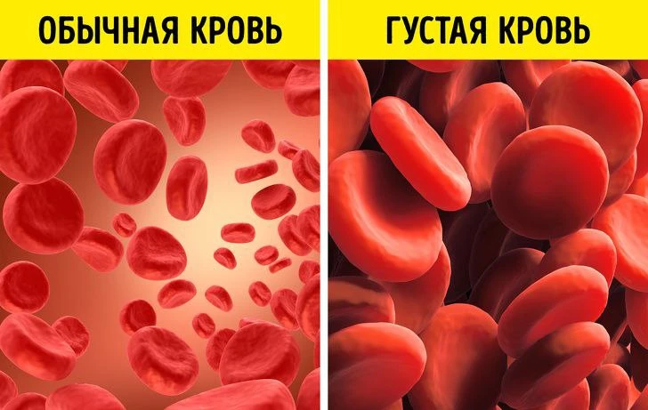 Профилактика образования тромбов