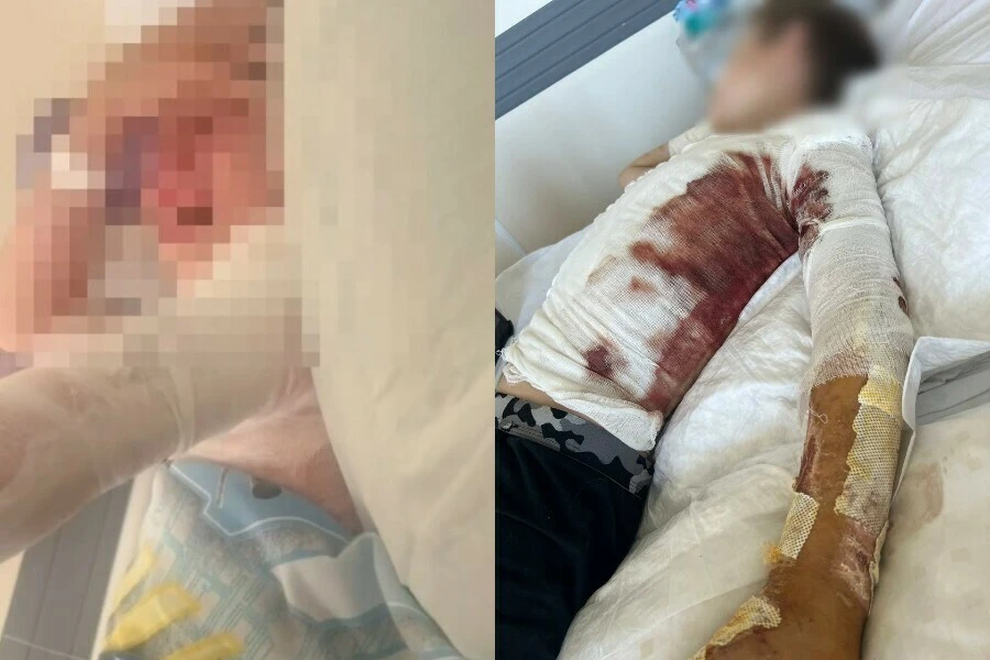 «Он стоял и смеялся над тем, как горит мой ребенок»: 10-летний мальчик получил тяжелые ...