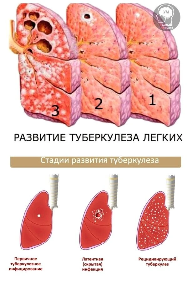 Стадии развития туберкулеза