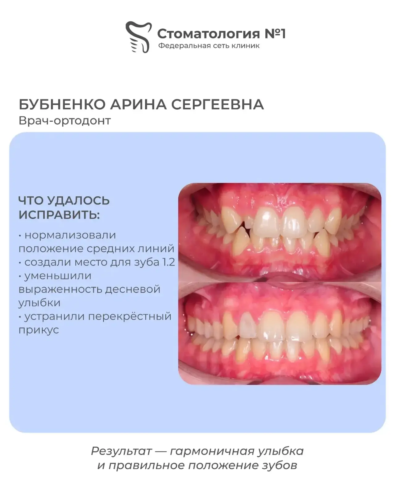 Ортодонтический кейс ✨