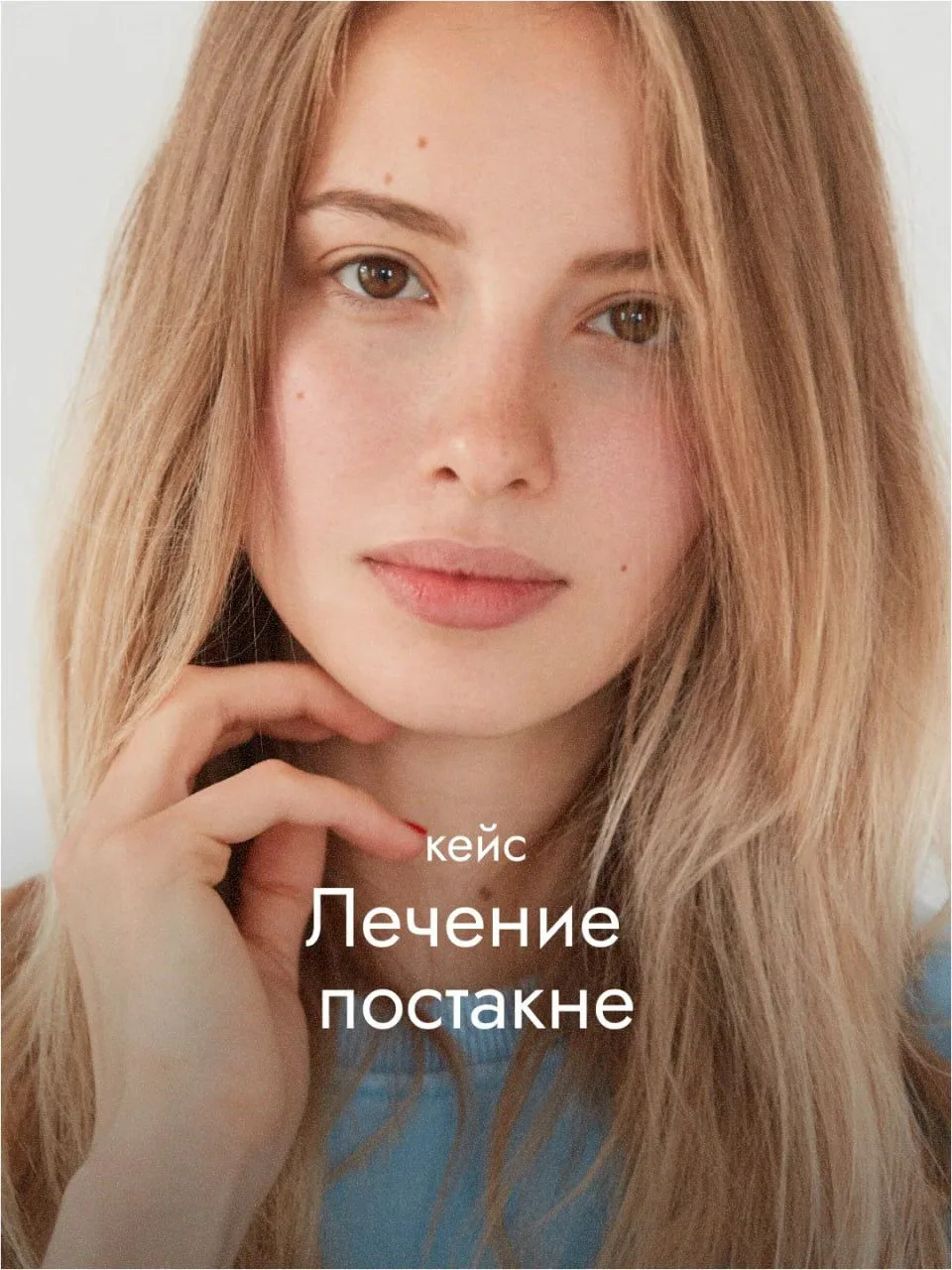 Кейс: комплексное лечение акне и постакне