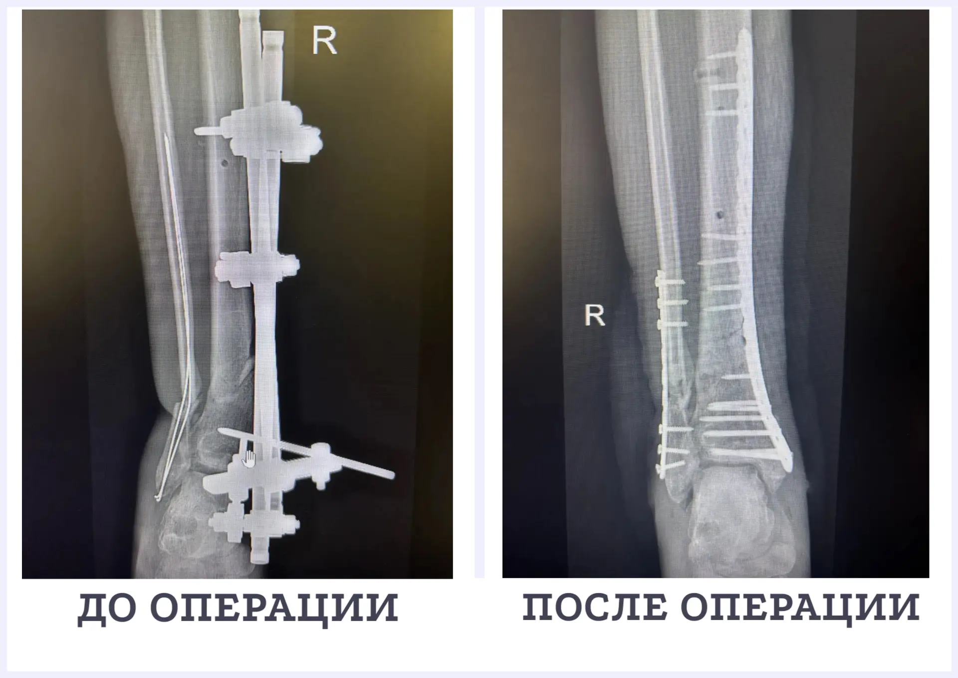 🦴👨‍⚕️Серпуховские врачи спасли ногу пациенту после тяжёлой травмы в Таиланде