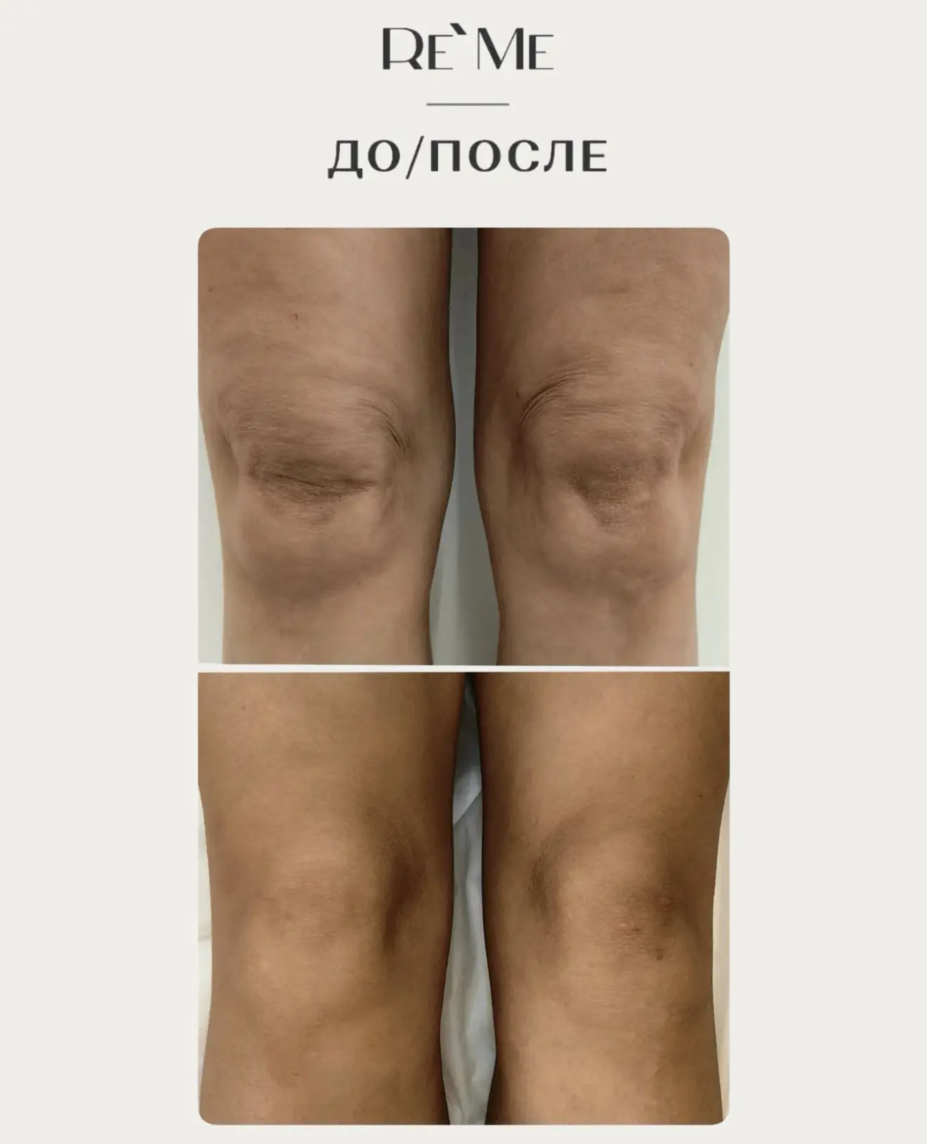 Подтянули кожу коленей без операции ✨