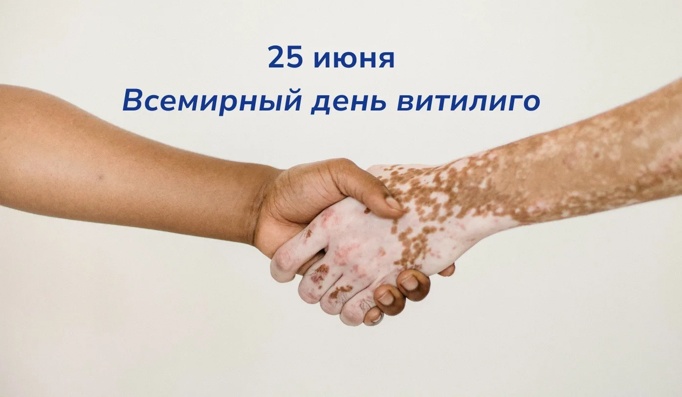 🟣🌍 25 июня — Всемирный день витилиго