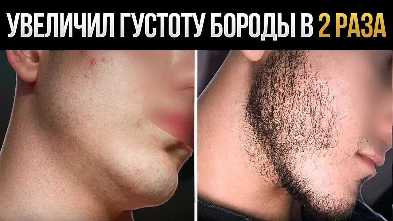 Результаты средства для роста бороды - наша традиционная рубрика! Сегодня на обзоре наш...