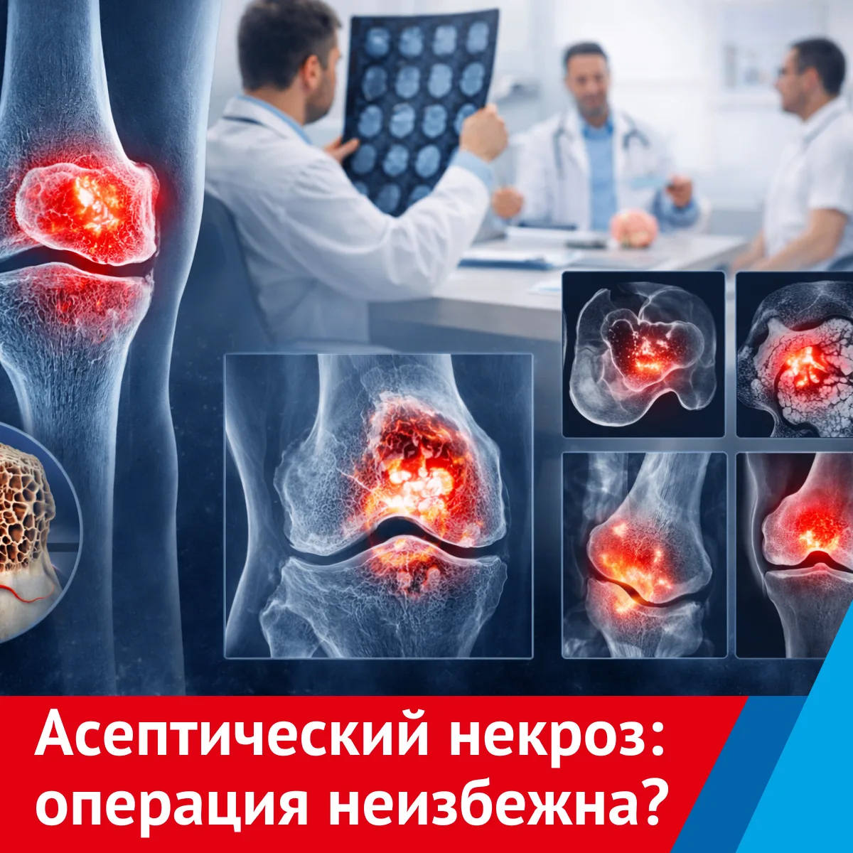 🦴 Асептический некроз: как спасают суставы в НМИЦ Приорова