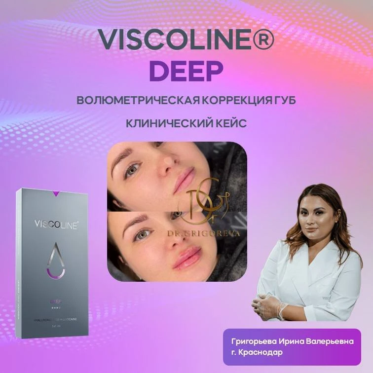 💋 АРХИТЕКТУРА ГУБ - ПРОПОРЦИИ, СИММЕТРИЯ И КОНТРОЛИРУЕМЫЙ ОБЪЕМ С VISCOLINE® DEEP

Современная эсте