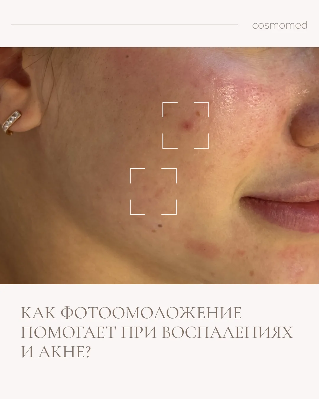 Как фотоомоложение помогает при воспалениях и акне?