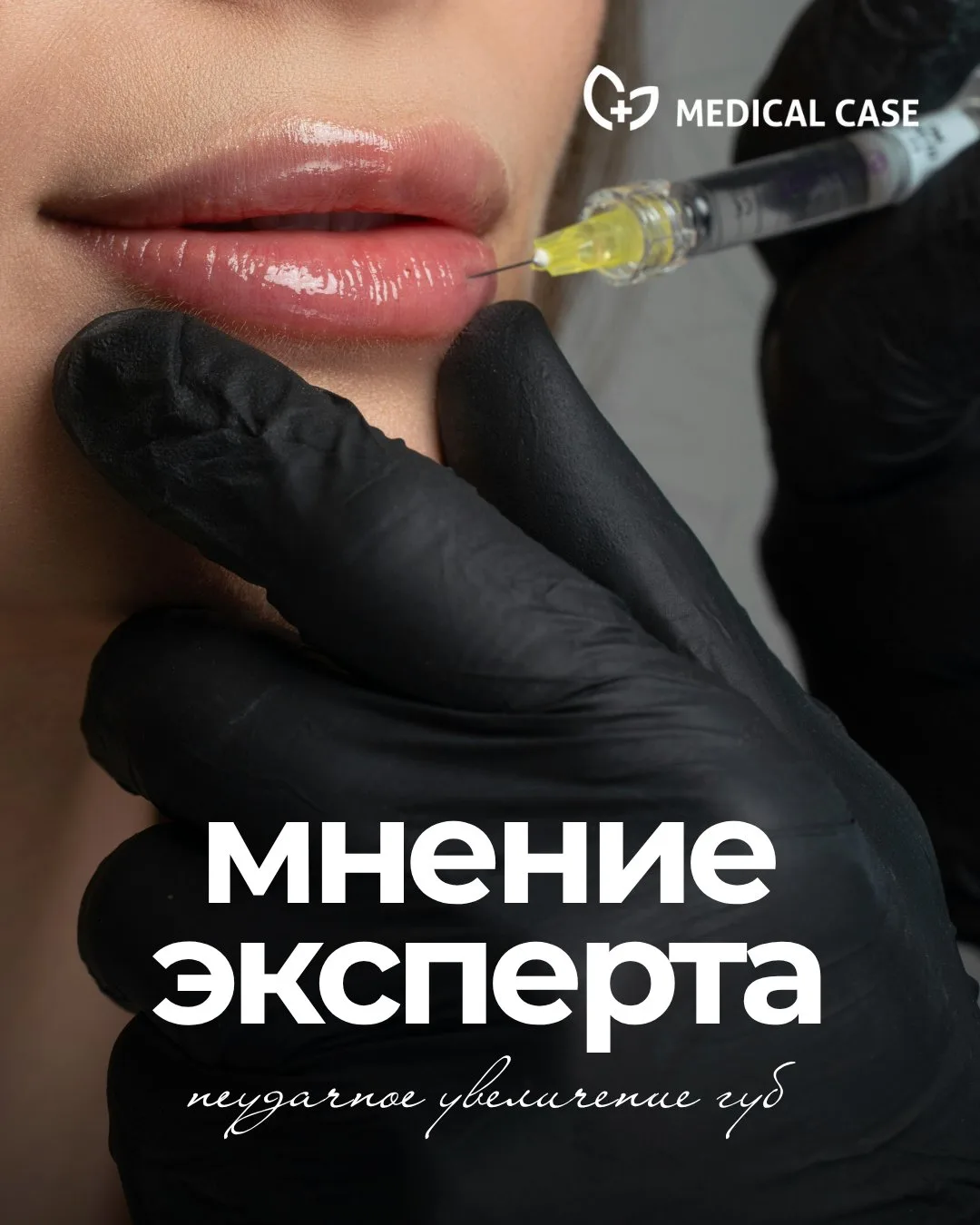 👄 Неудачное увеличение губ: как помочь пациентке?

Уважаемые коллеги, в профессиональном сообществе