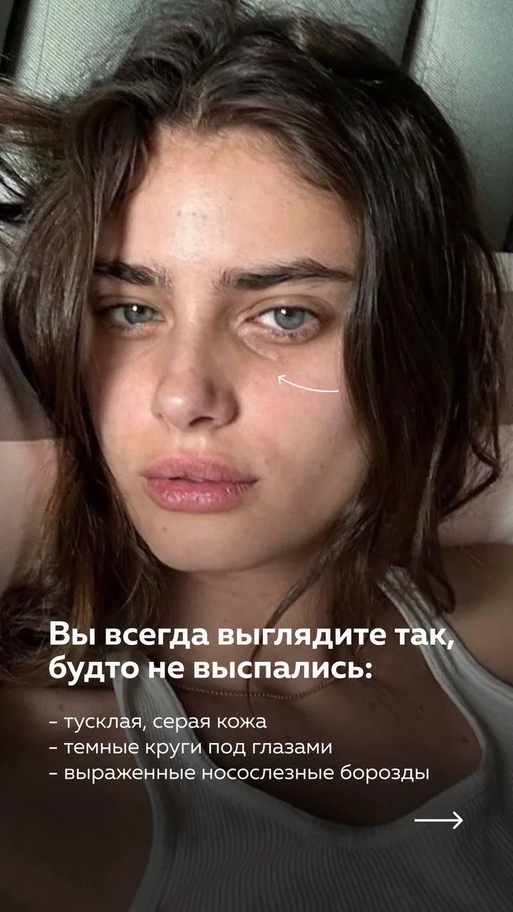Чекап лица: склонны ли вы к птозу? 🫠