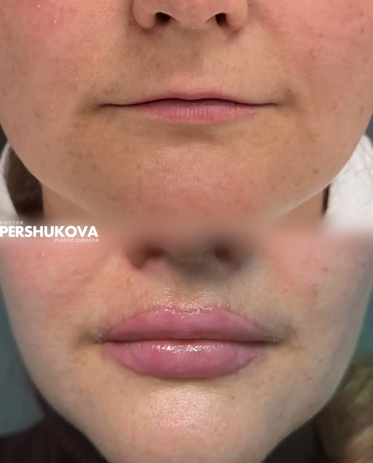 Пластика губ «Кессельринг» в процессе и с результатом через 7 дней от Анны Петровны Першуковой

Прай