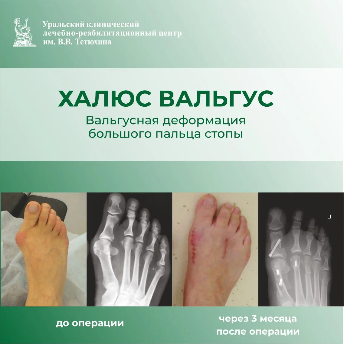 Халлюс Вальгус: