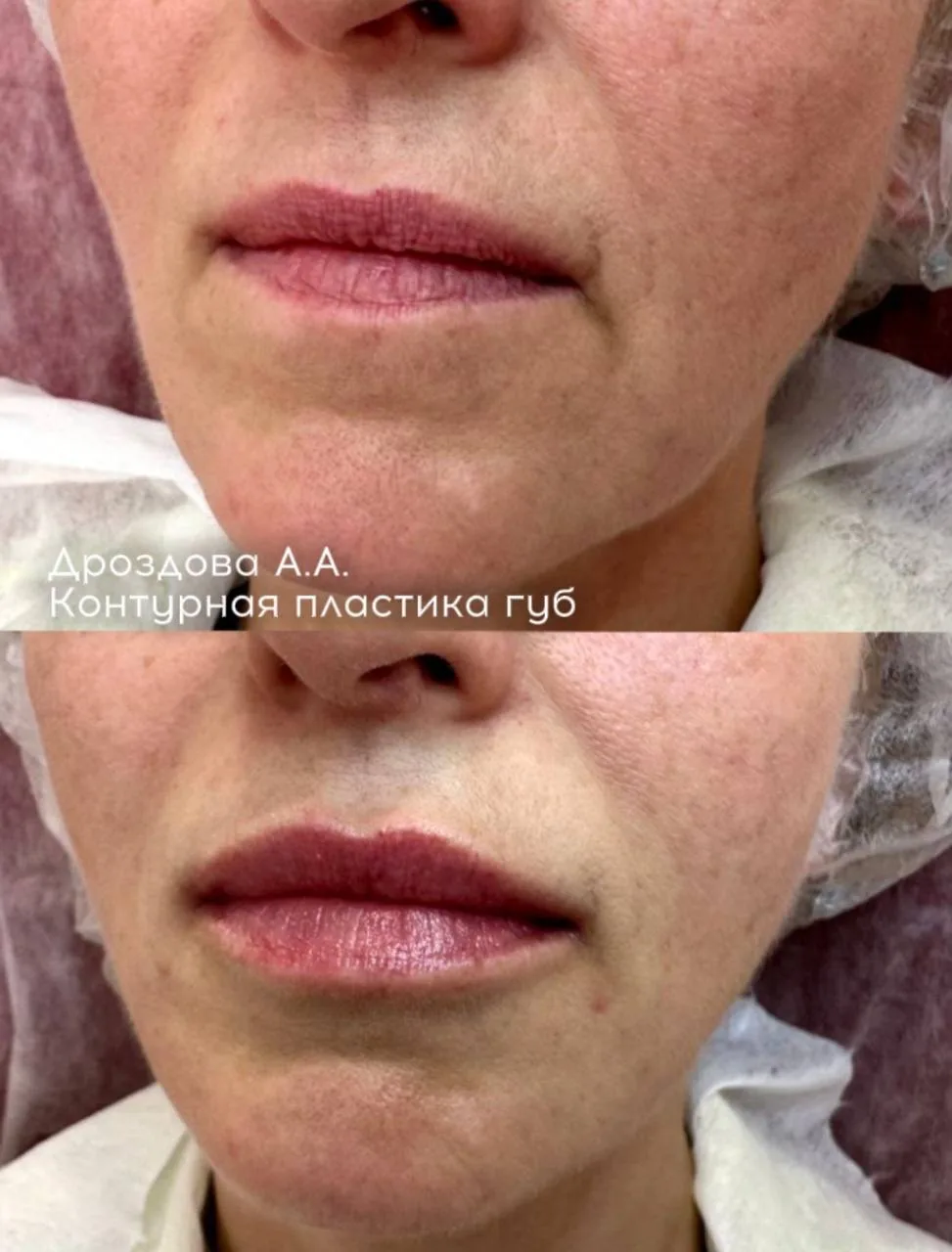 Работа врача-косметолога #арклиник Дроздовой Анны Андреевны.