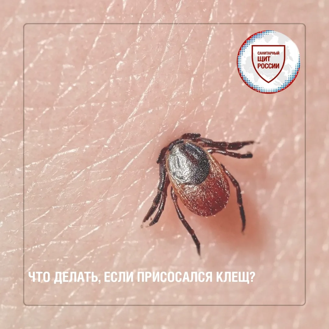 Укус клеща может остаться незамеченным, поэтому после прогулок в лесу🌳, парке или на даче важно вни
