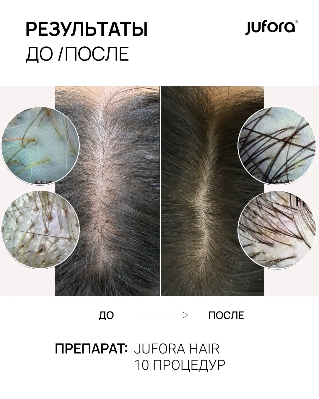 Сегодня в кадре: мезотерапия волос препаратом JUFORA® HAIR 💆‍♀️
10 процедур, и результат говорит са