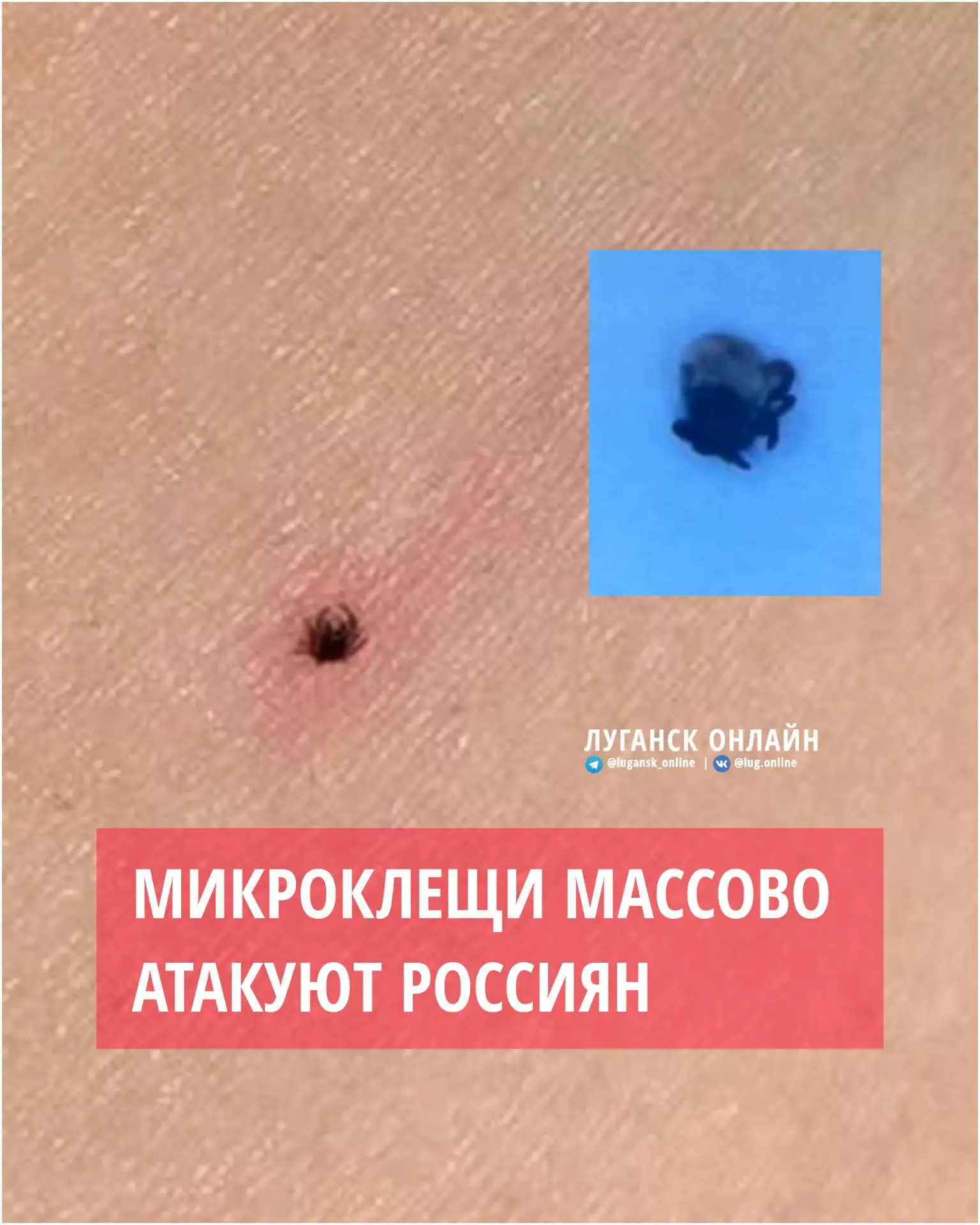 ❗️Микроклещи массово атакуют россиян