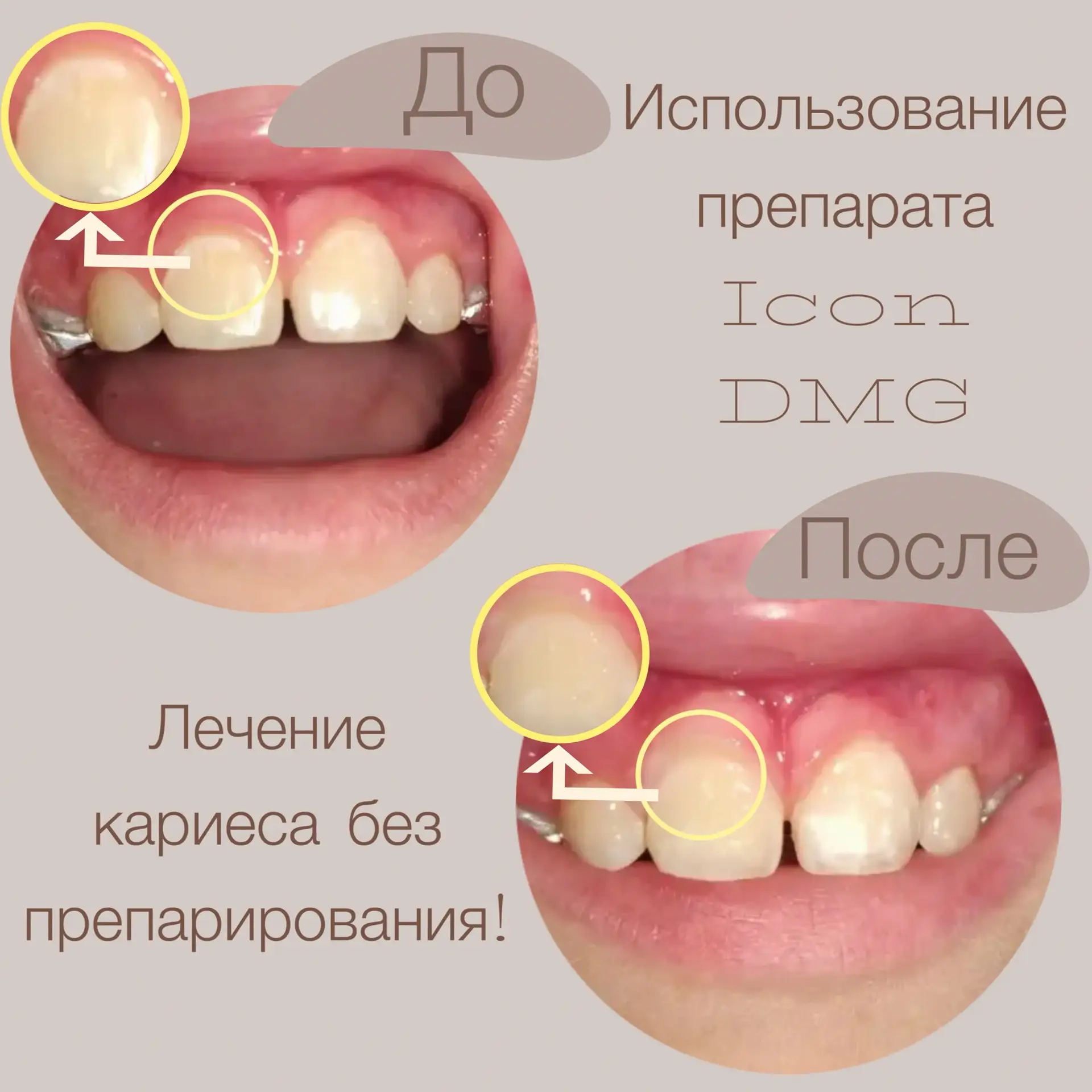 "Меловидное" пятно является начальной формой кариеса.