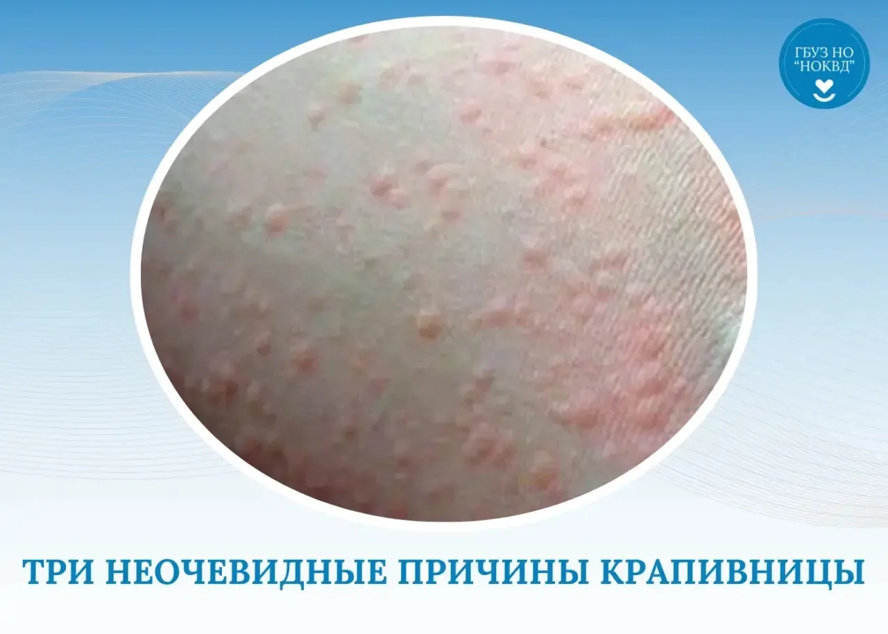 🤯 Три неочевидные причины крапивницы