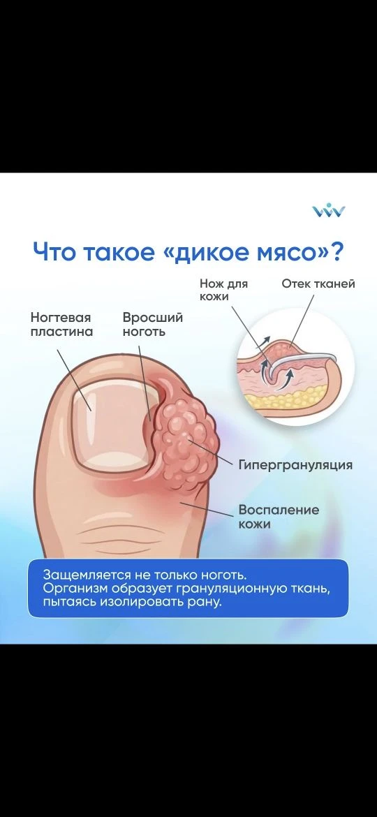 Гипергрануляция: когда организм «перестарался» с защитой ❌