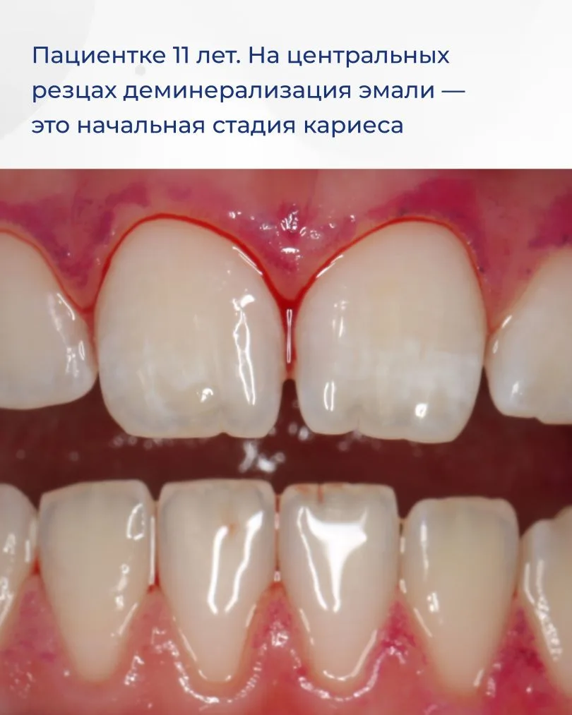 Устраняем дисколорит зубов за одну процедуру! Как это возможно? Сейчас расскажу! Пациентке 11 лет. Б