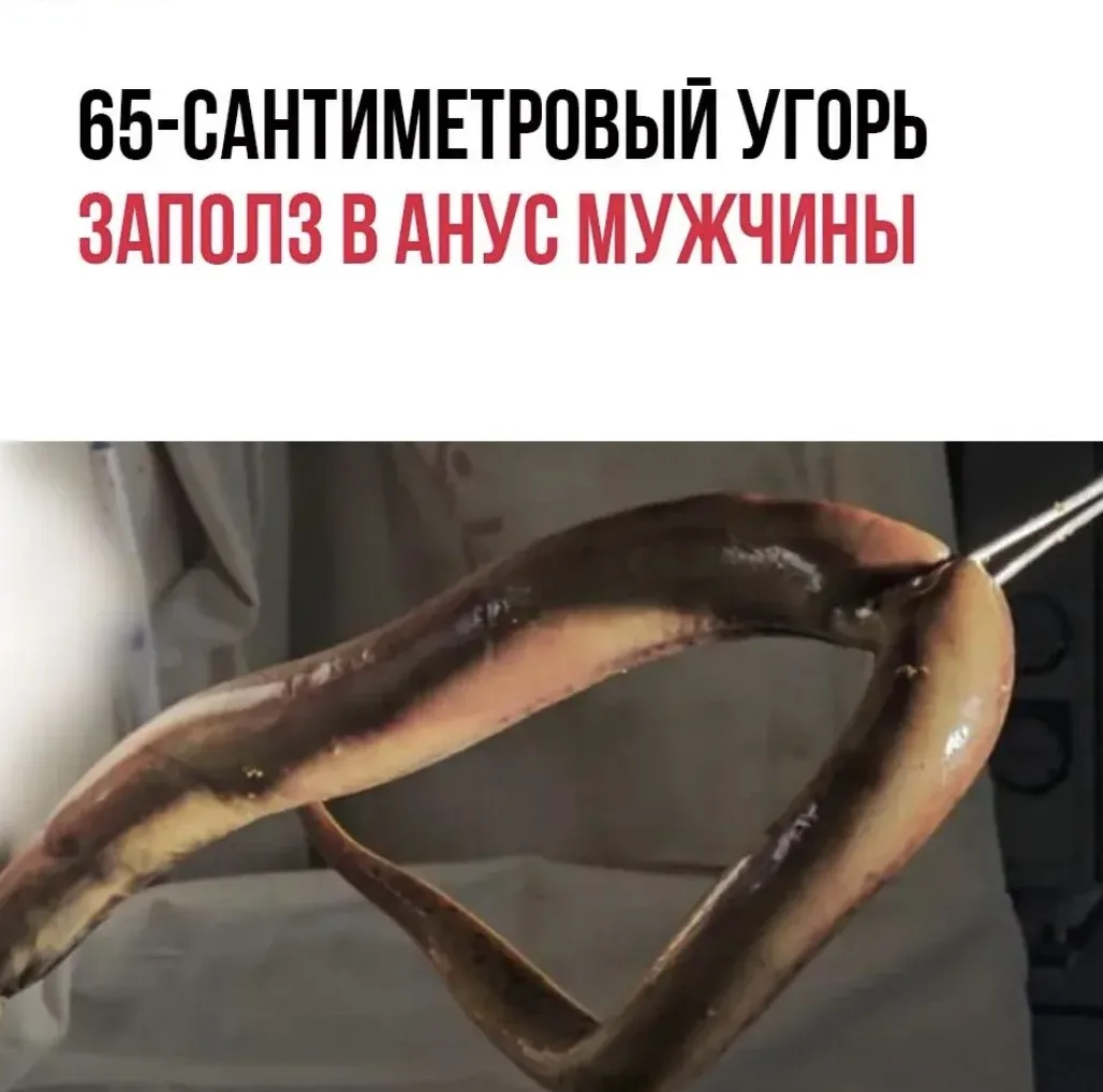 Живого угря длиной 65 сантиметров извлекли из кишечника 55-летнего мужчины врачи в Бангладеш. Рыба п