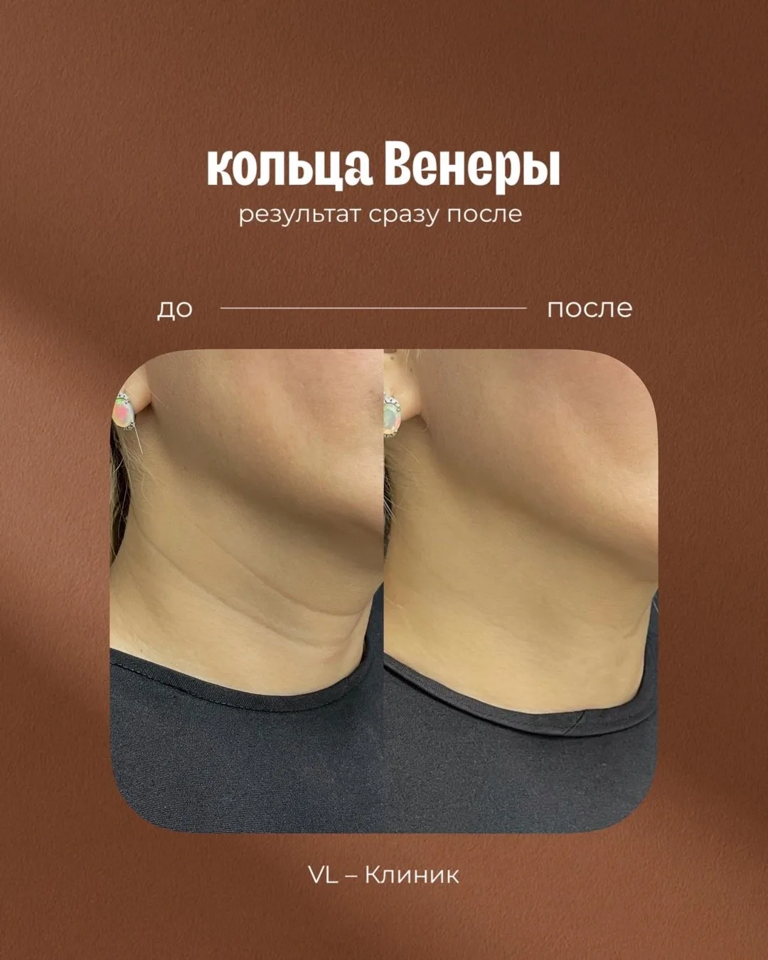 Убираем «кольца Венеры» в VL Клиник ✨