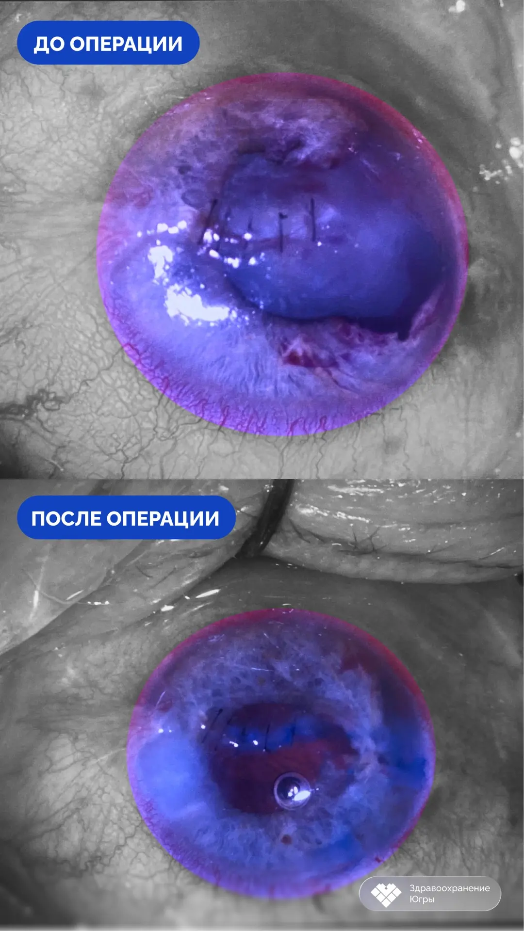 Врачи Сургутской окружной клинической больницы сохранили зрение и глаз 58-летнему рыбаку