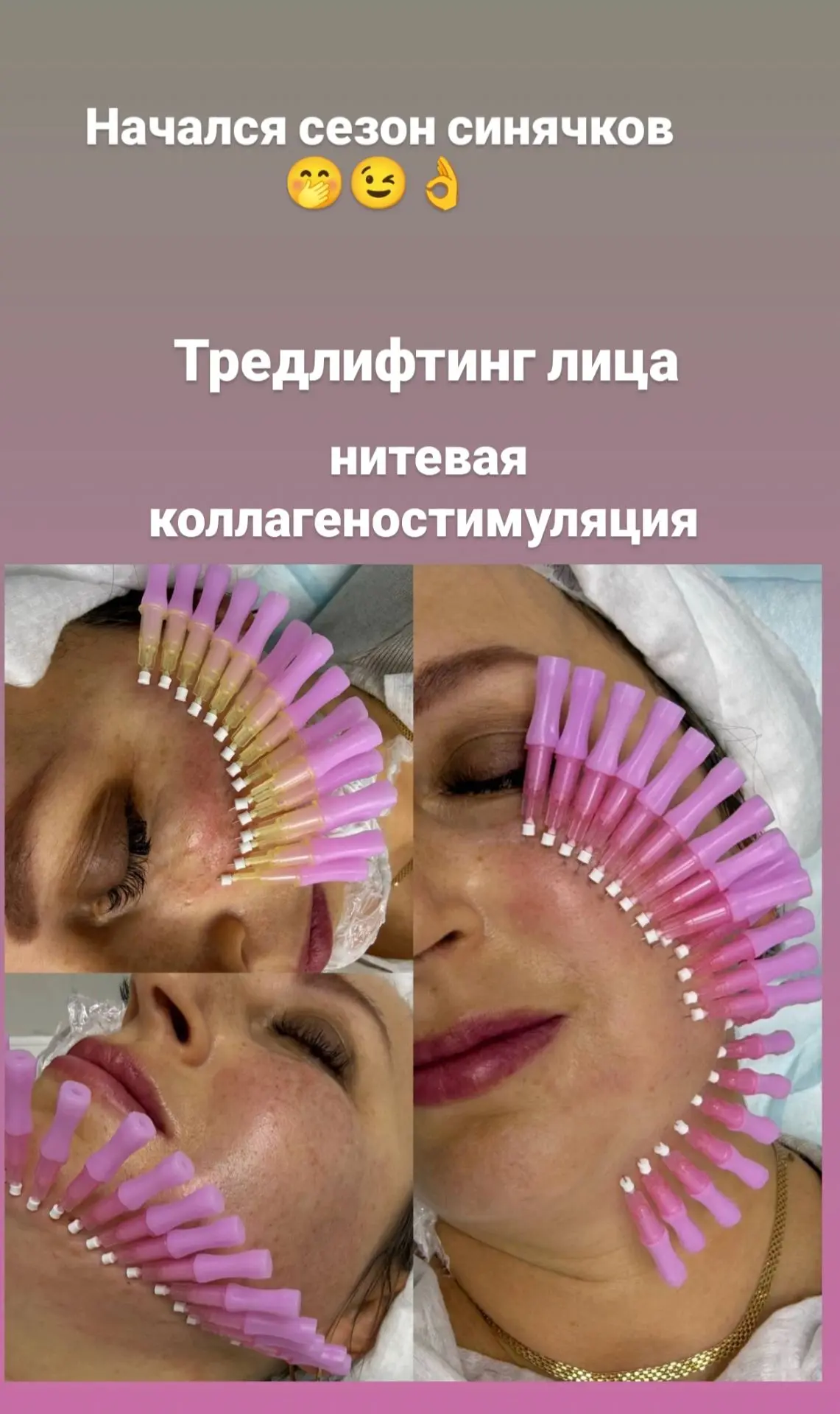 ТРЕДЛИФТИНГ ✨