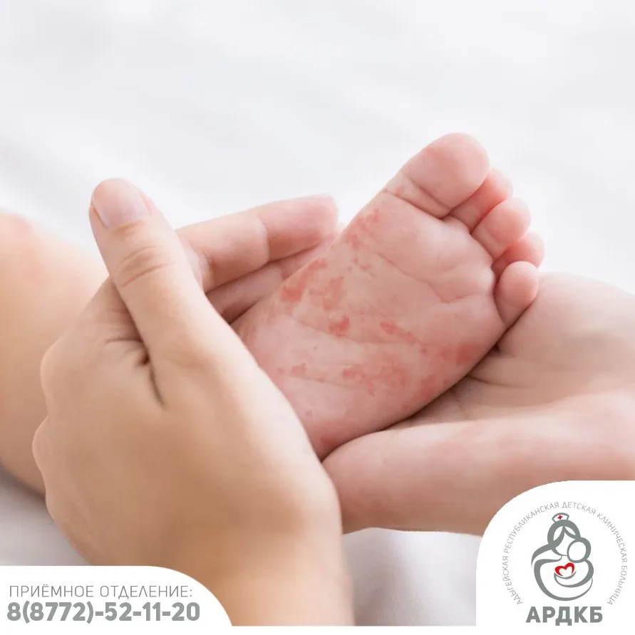 ❗ Кожные высыпания у малышей: когда беспокоиться? 🩹👶