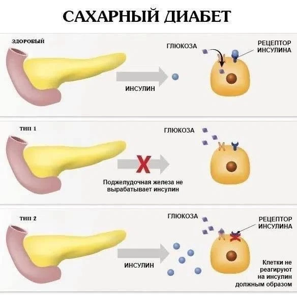 Сахарный диабет 2 типа — хроническое заболевание. Если не поддерживать тот уровень глюк...