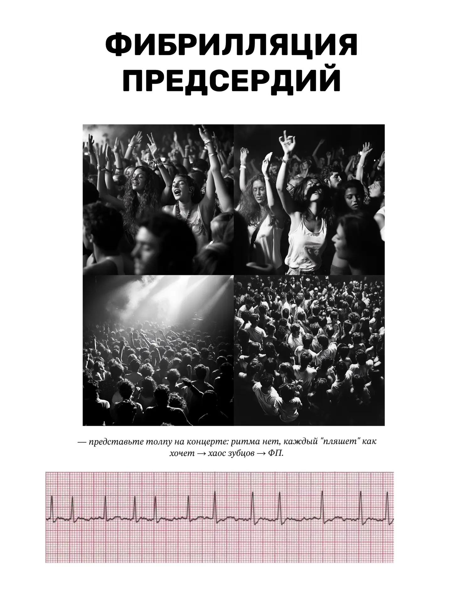 Фибрилляция предсердий =толпа на концерте
