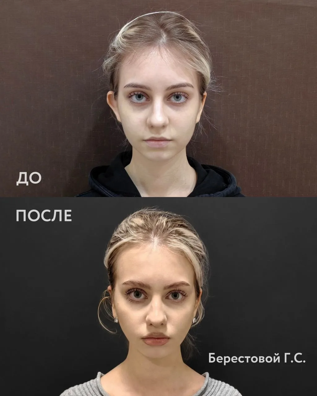 Отопластика — популярная пластическая операция, направленная на коррекцию формы, размер...