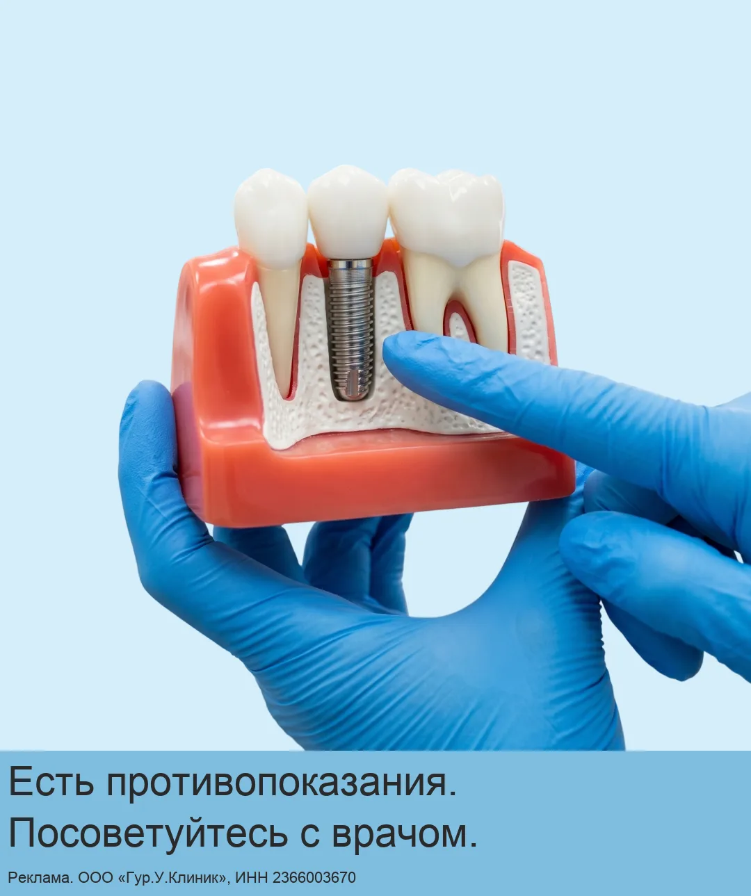 Имплантация зубов в Сочи у врачей с практикой до 26 лет!