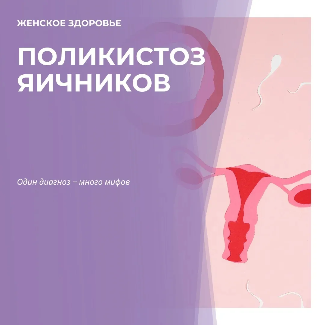 Поликистоз яичников: один диагноз — много мифов