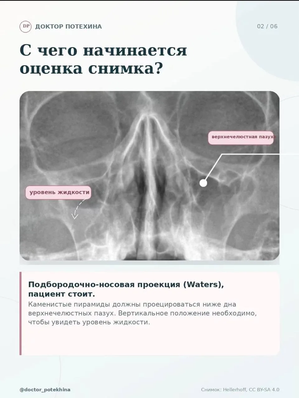 💀Верхнечелюстной синусит