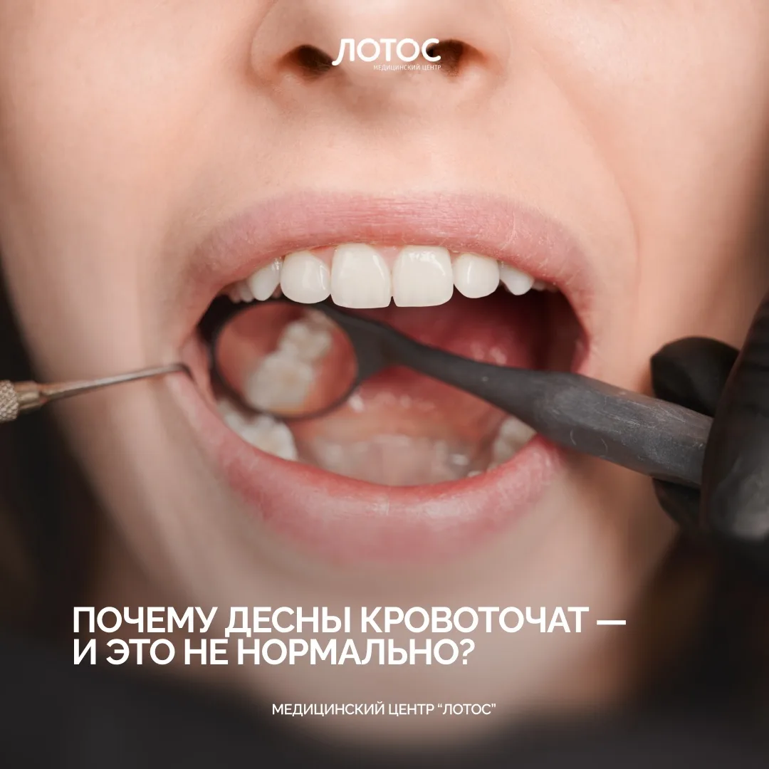 Многие замечают кровь во время чистки зубов и думают: «Наверное, слишком сильно надавил щёткой».

Но