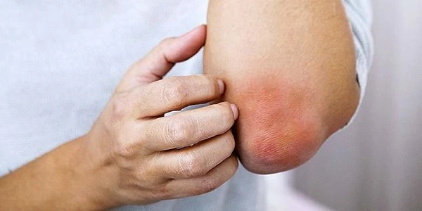 💉Диабетическая эритема – наиболее часто встречающиеся кожное проявление при сахарном д...