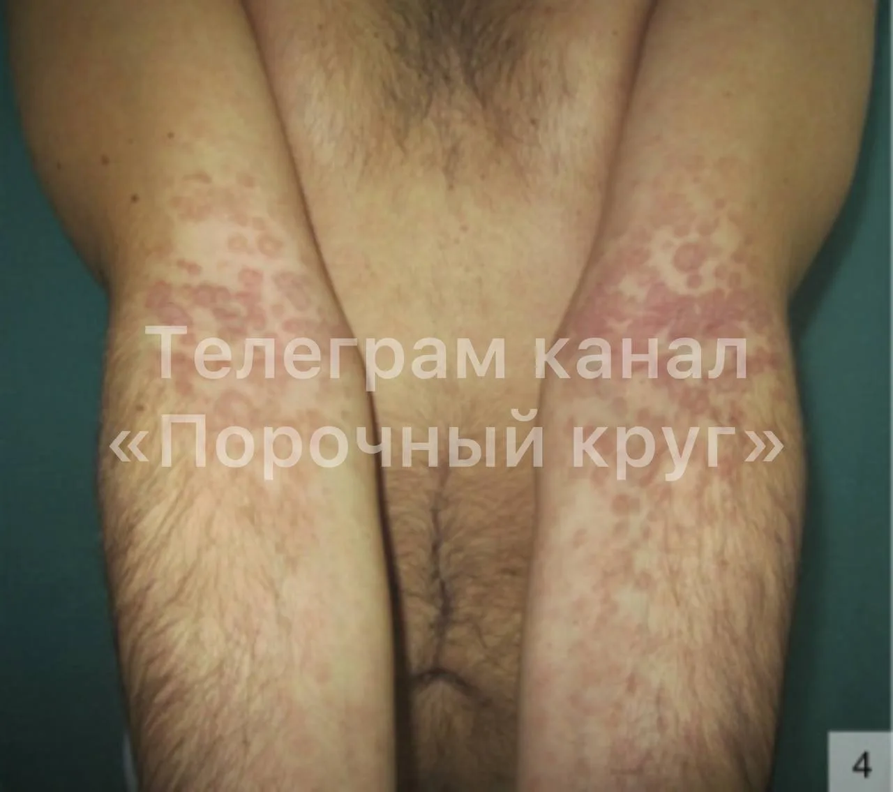 Аня и её любовник с сифилисом.  2008 или 2009 год.  Аня. Сирота. Воспитывалась бабушкой. Молодая, ми
