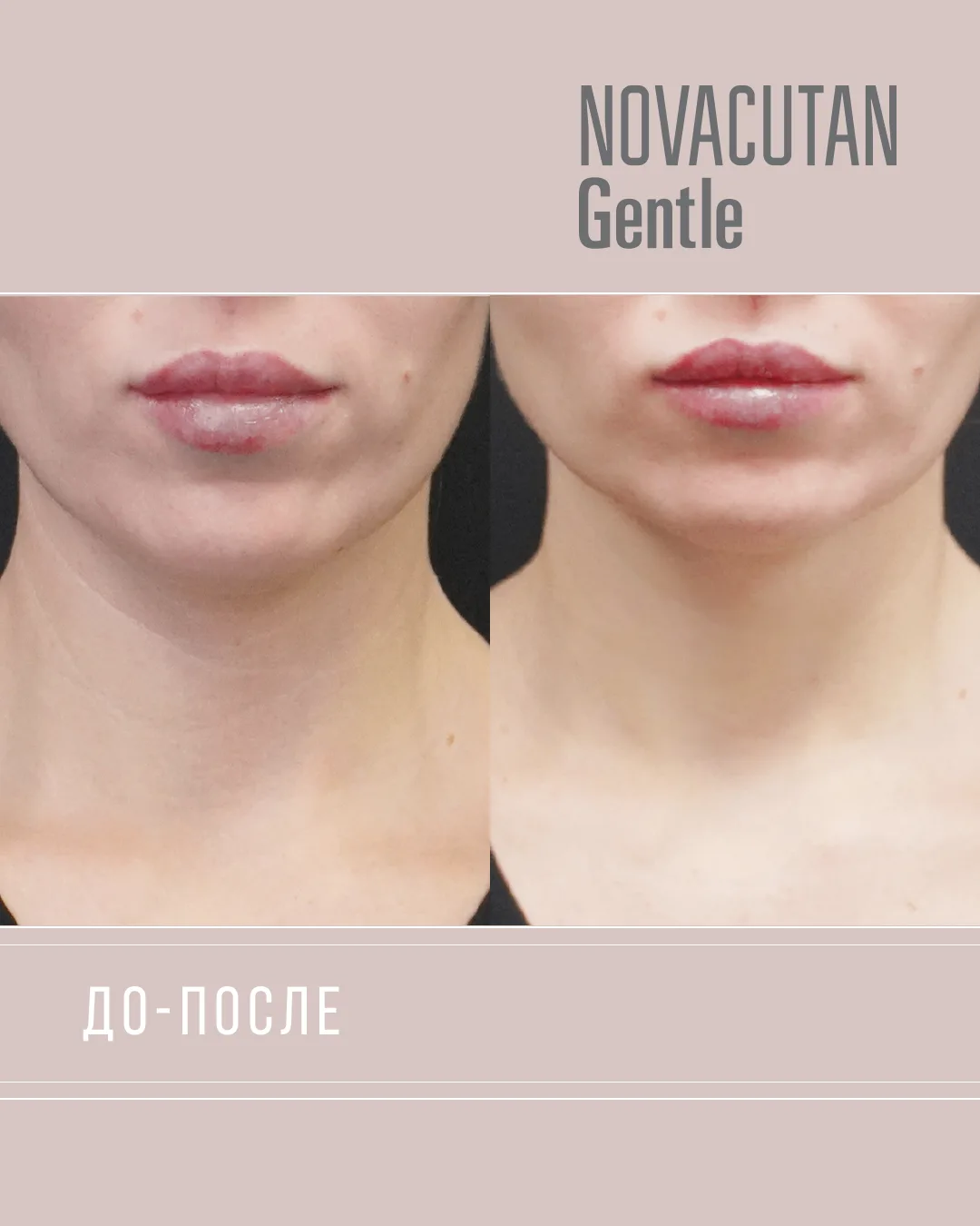 ДО/ПОСЛЕ 
Novacutan Gentle  

Биомониторинг и Экокоррекция Микробиома Delicate Zone Care 

Анна, 31 
